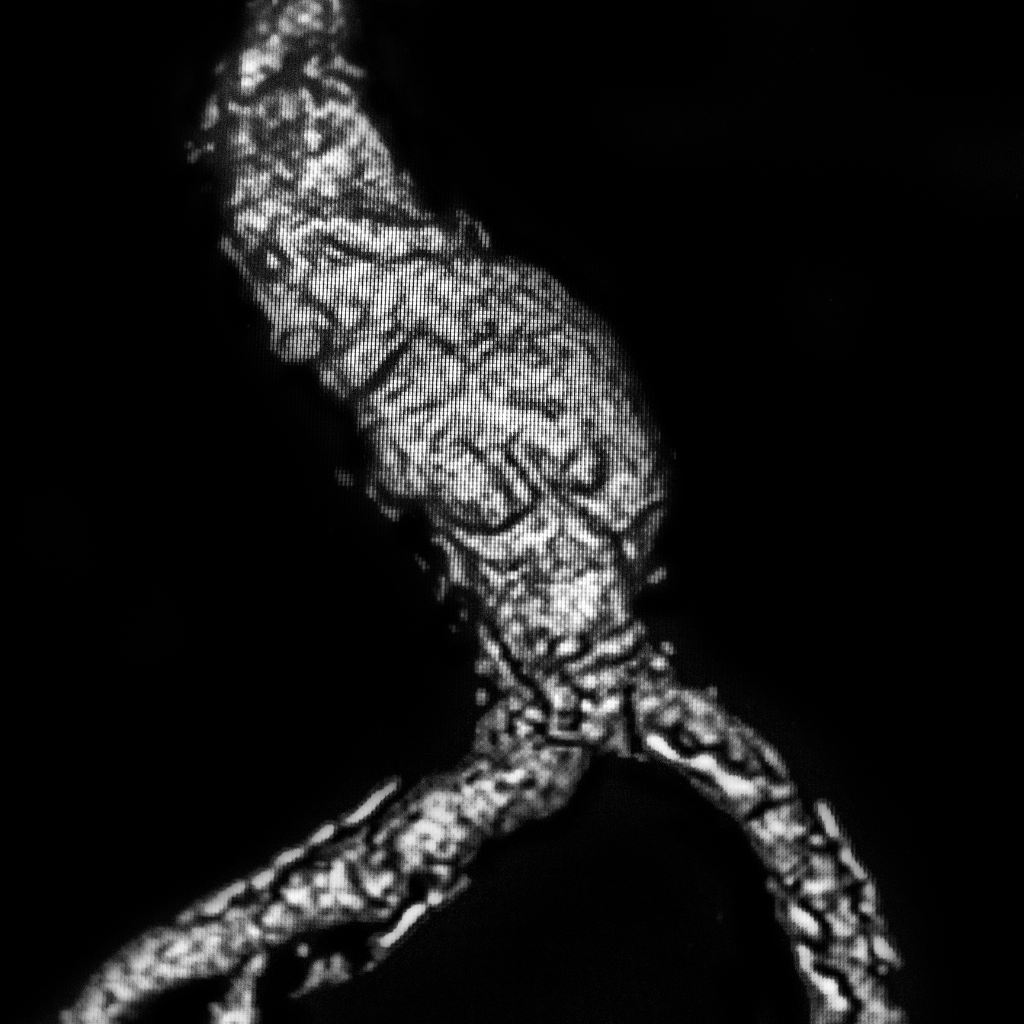 ilustração de aneurisma abdominal
