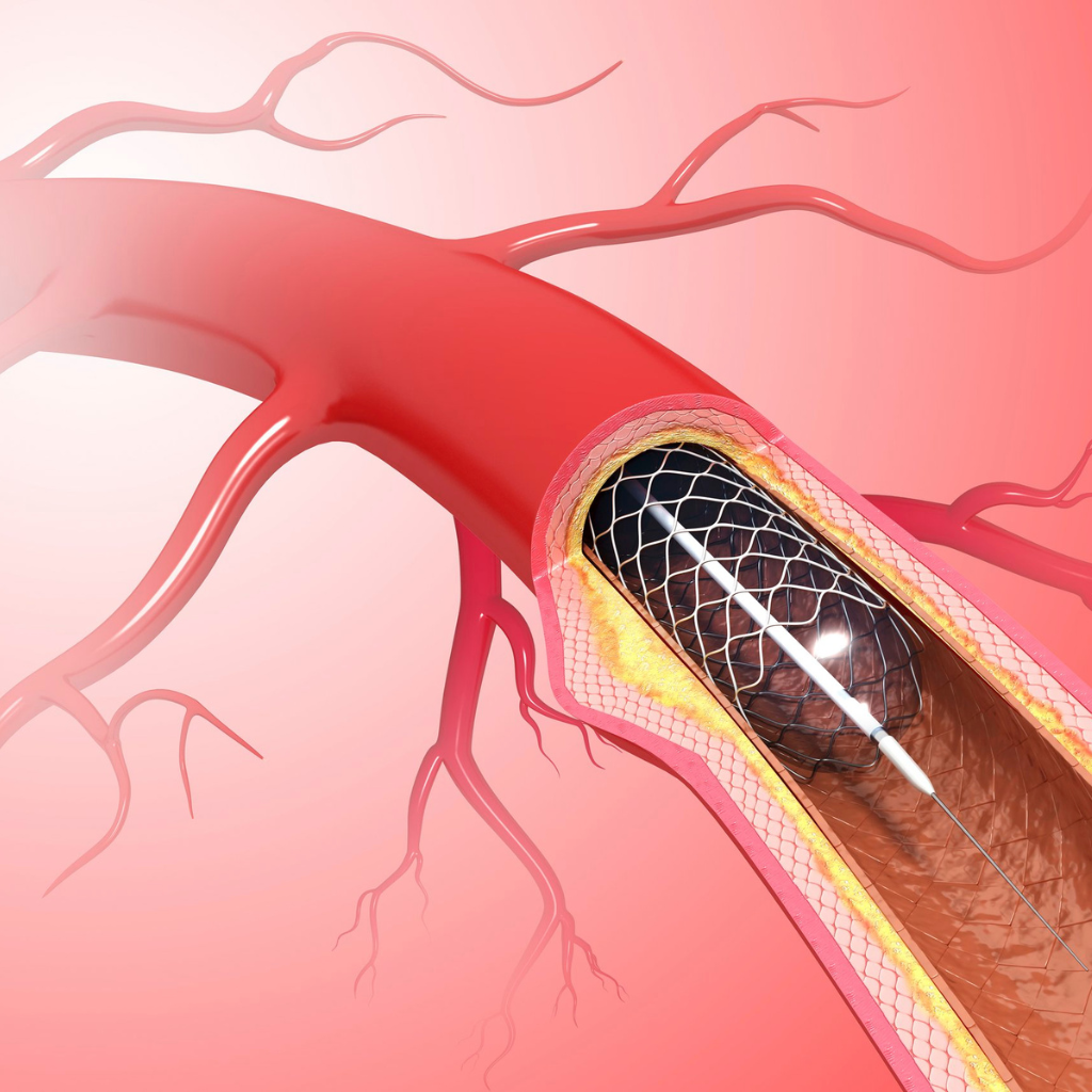 ilustração de angioplastia na carótida