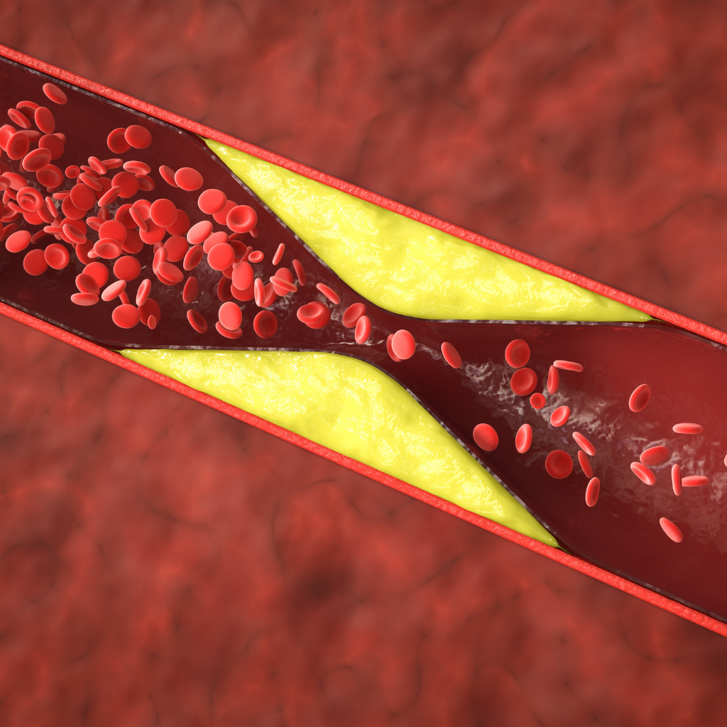 stent na artéria mesentérica após angioplastia