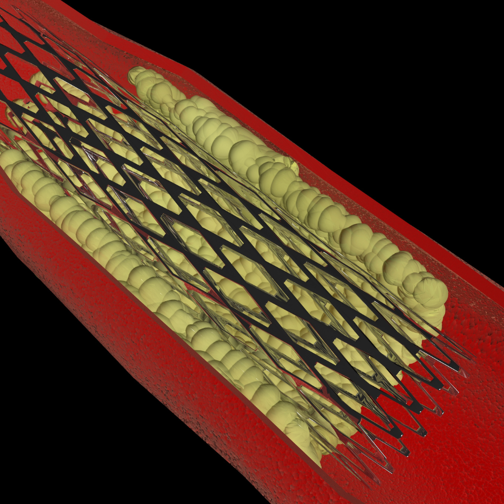 stent na artéria mesentérica após angioplastia