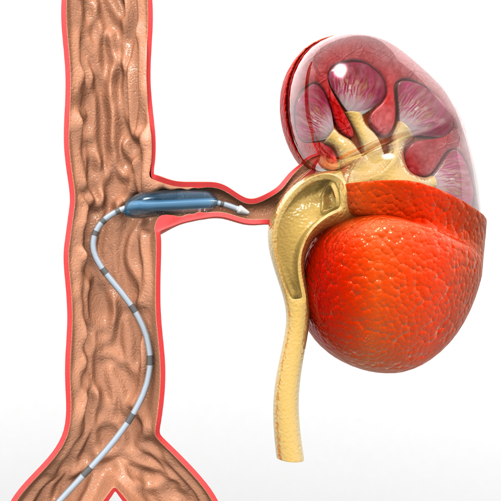 stent na artéria renal após angioplastia