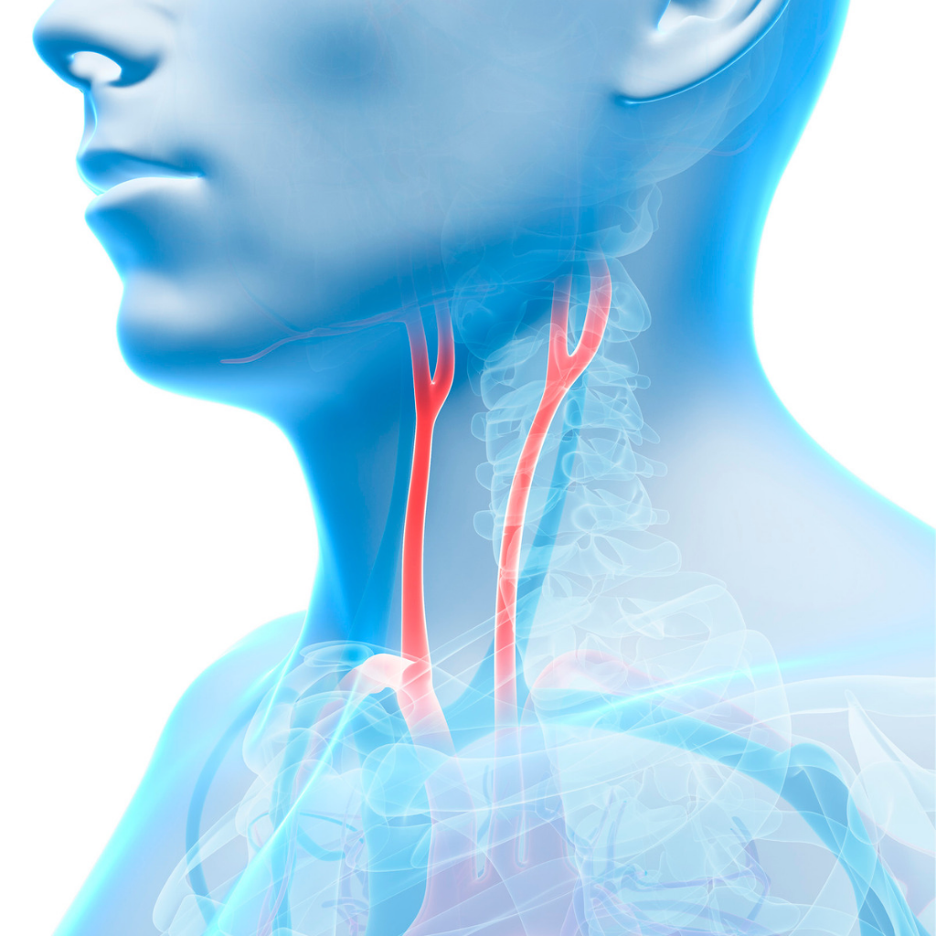 angioplastia de carotida