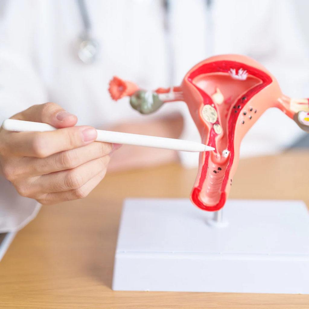 médico explicando embolização de mioma uterino para paciente em Londrina